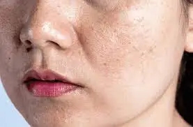 When will I see the results? Understanding healing, scabbing, scar prevention, and pigmentation changes Gateshead