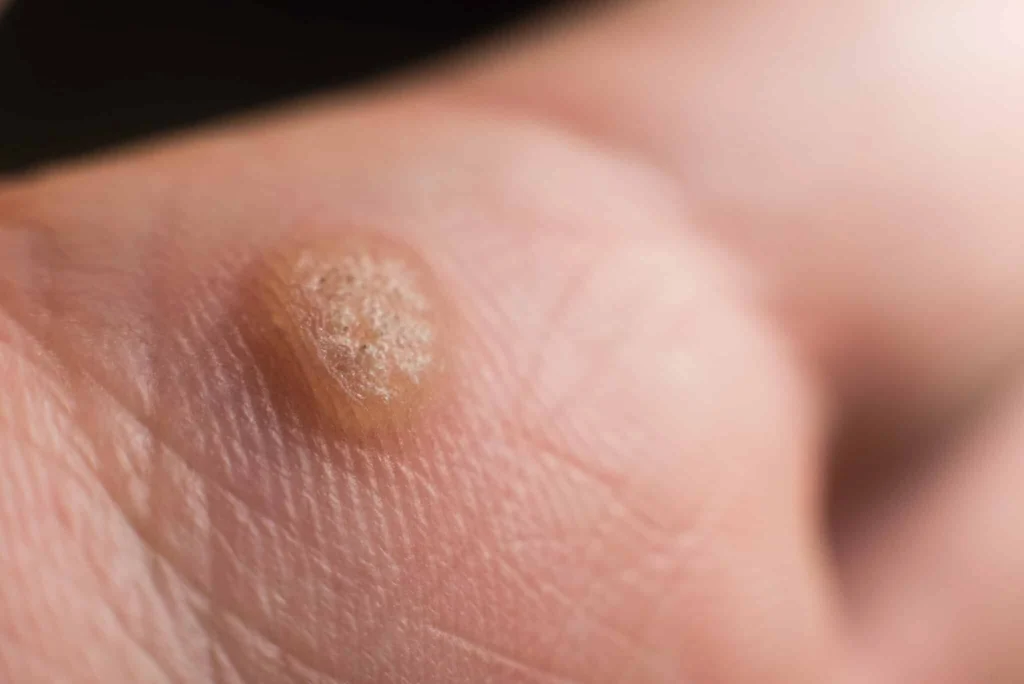 CryoPen treatment for Common Warts showing precise freezing of viral skin lesions for safe and effective removal Gateshead